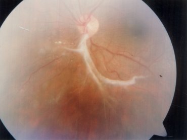 Corneal Abscess